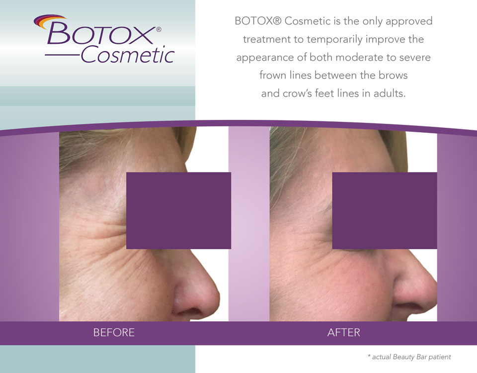 Before and after Botox for Crow's Feet