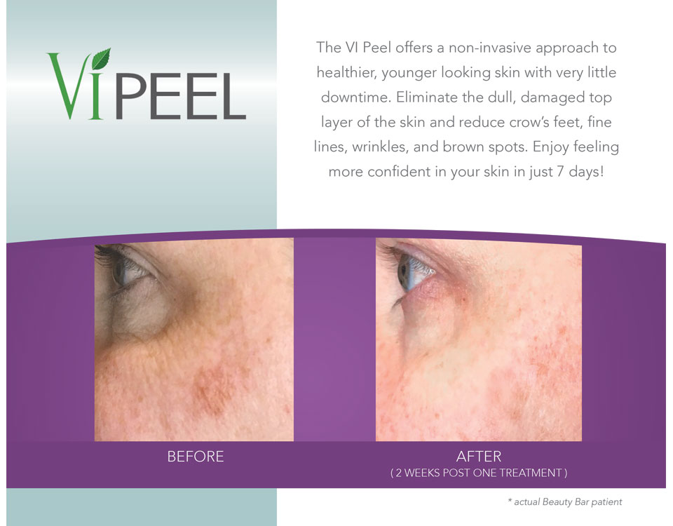 Before and after ViPeel for brown spots
