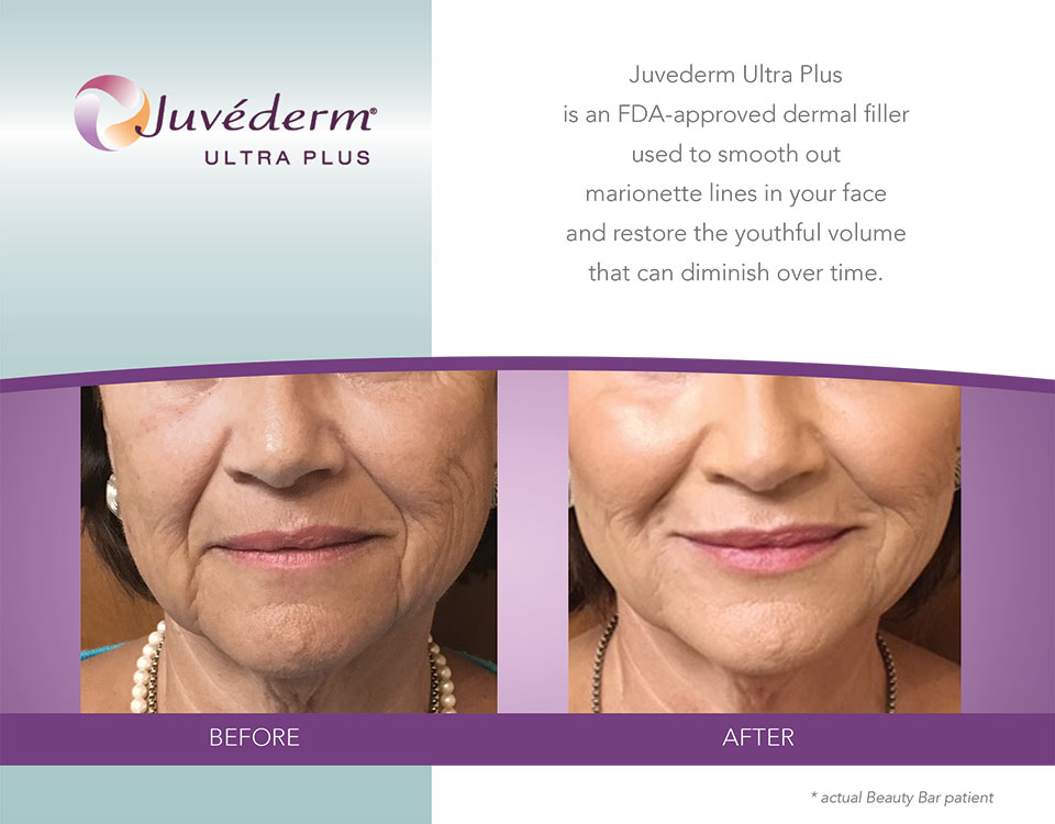 Juvederm Ultra Plus before and after marionette lines