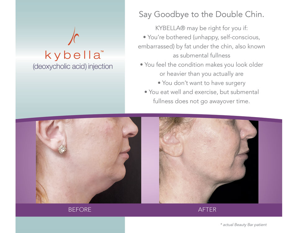 Kybella treatment before and after Beauty Bar Medispa