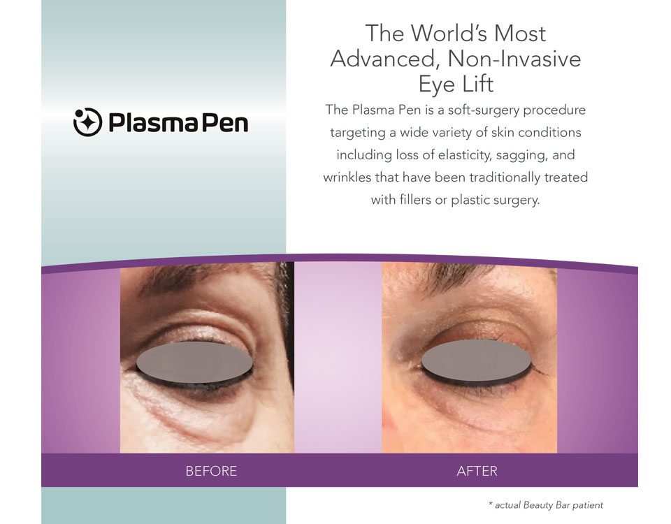 Before and after Eyelift with Plasma Pen