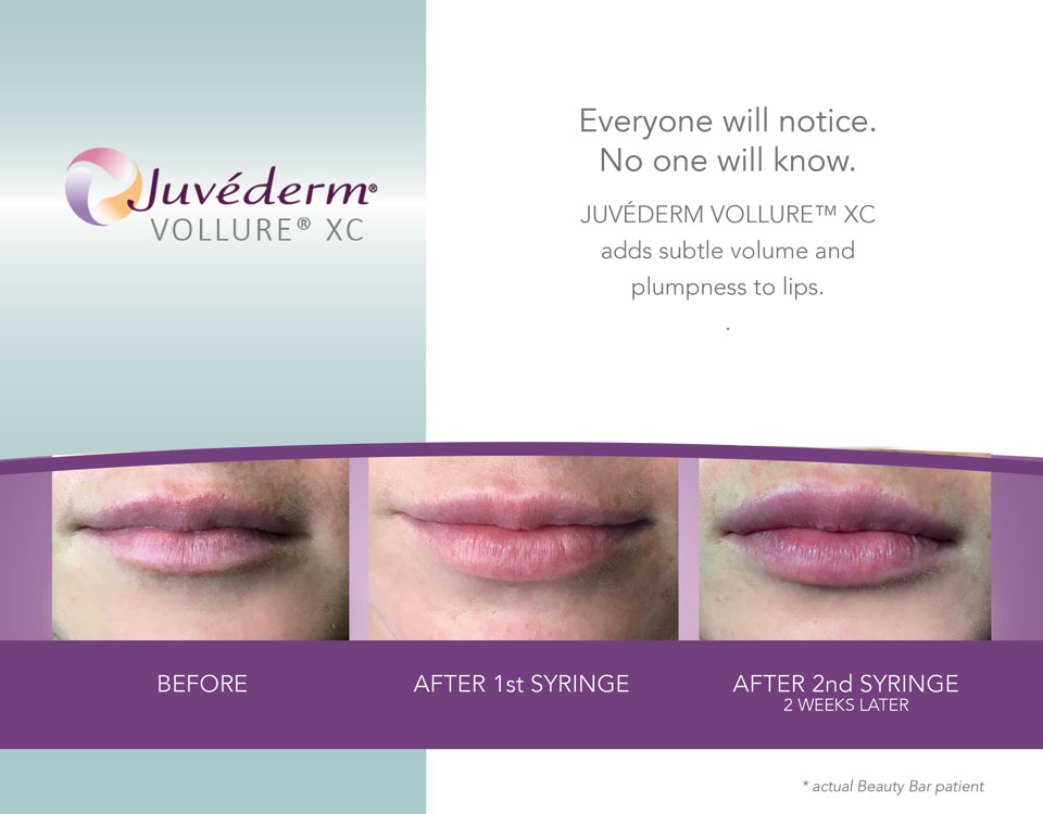 Beauty Bar Medispa before and after lip volume