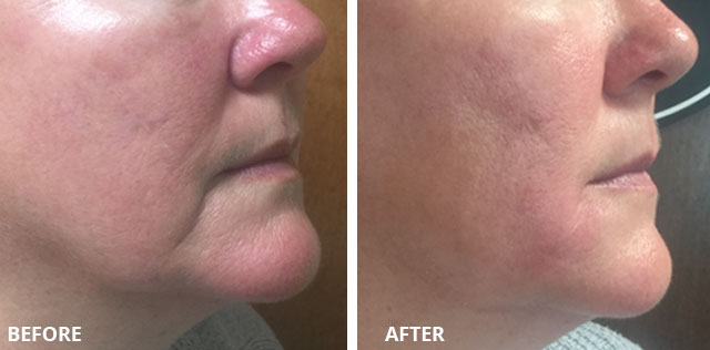 Juvederm Ultra Plus for deeper folds and wrinkles