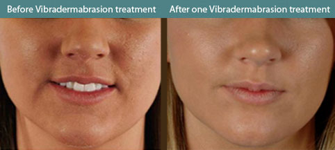 Vibraderm before and after