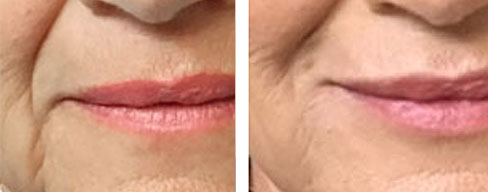 Vollure before and after photo of actual Beauty Bar Medispa patient in Greensville, NC