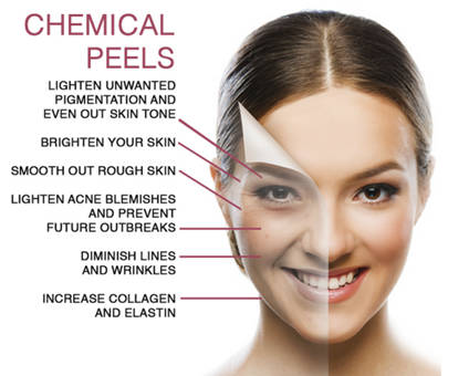 Benefits of a chemical peel