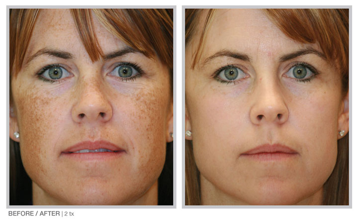 Broad Band Light (BBL) technology for long-term skin improvement results
