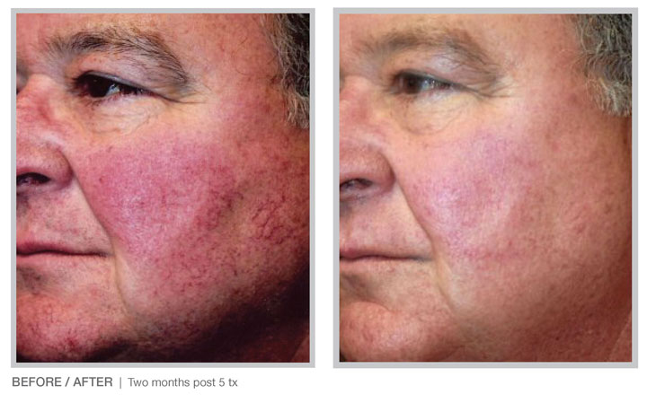 Broad Band Light (BBL) technology for long-term skin improvement results