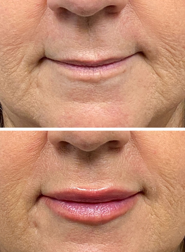 Juvederm Ultra before and after