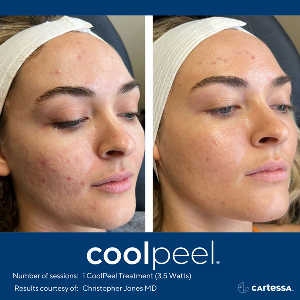 CoolPeel for acne scarring