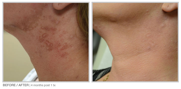 Immediately after a Halo treatment, you will begin to see healthier, more youthful looking skin.